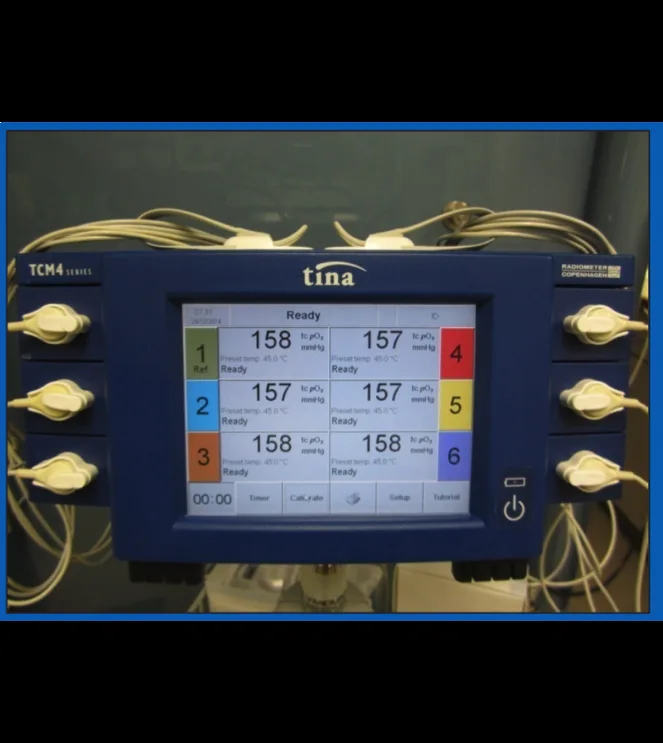 Hyperbaric monoplace unit integrated into Burns & Plastic Surgery Dept